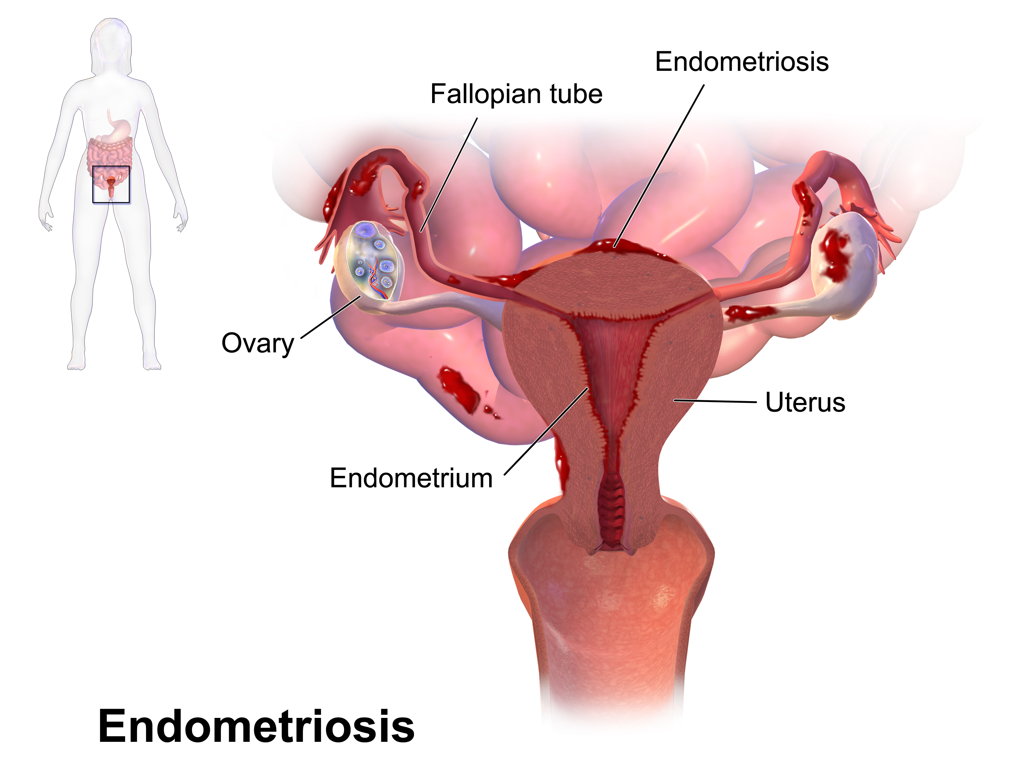 Diagram depicting Endometriosis lesions around female reproductive organs
