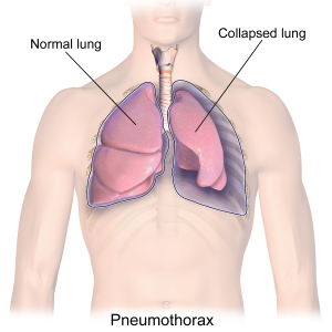 Graphic depicting a pneumothorax (collapsed lung)