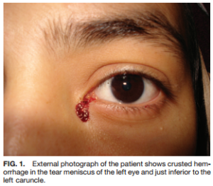 Photo of young girl with blood coming out of tear duct, suspected due to Endometriosis