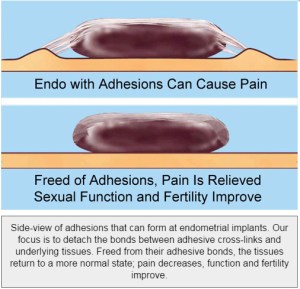 Graphic depicting adhesions around endometriosis