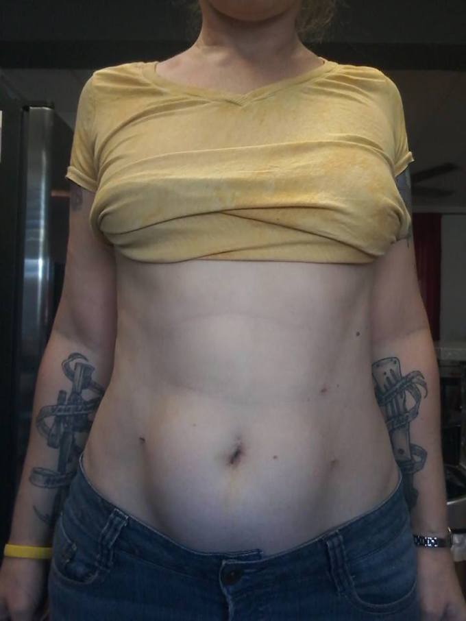 Photo of bare abdomen after surgery
