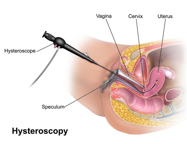 Diagram of a hysteroscopy