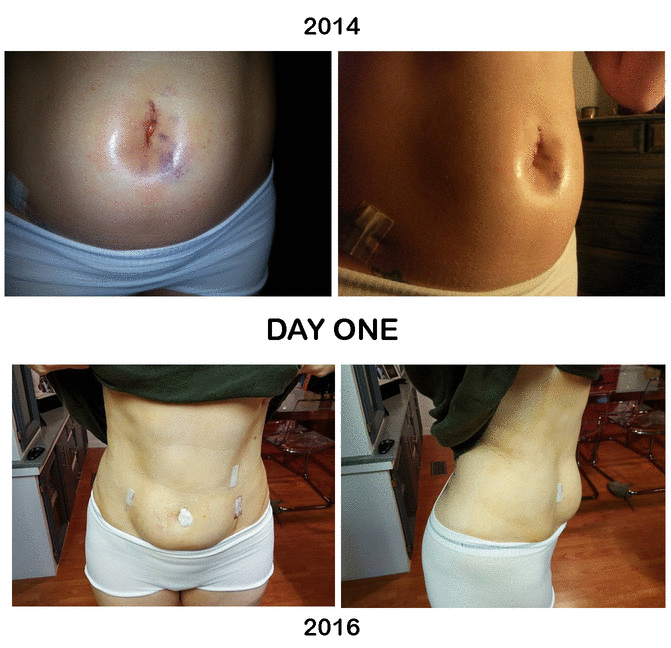 Slideshow of incisions during surgery recovery