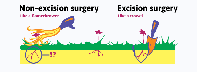 graphic depicting difference between ablation and excision (burning versus cutting)