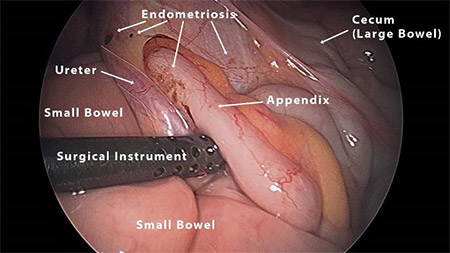 Photo of Endometriosis on the appendix, taken by Dr. Andrew Cook of Vital Health Institute