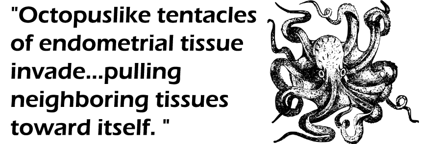 An octopus with text that reads "Octopuslike tentacles of endometrial tissue invade...pulling neighboring tissues toward itself."