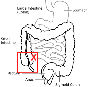 My 4th Endo Excision Surgery Bloomin Uterus