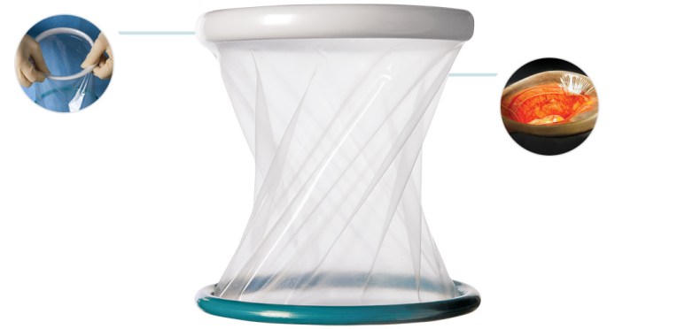 My 4th Endo Excision Surgery Bloomin Uterus