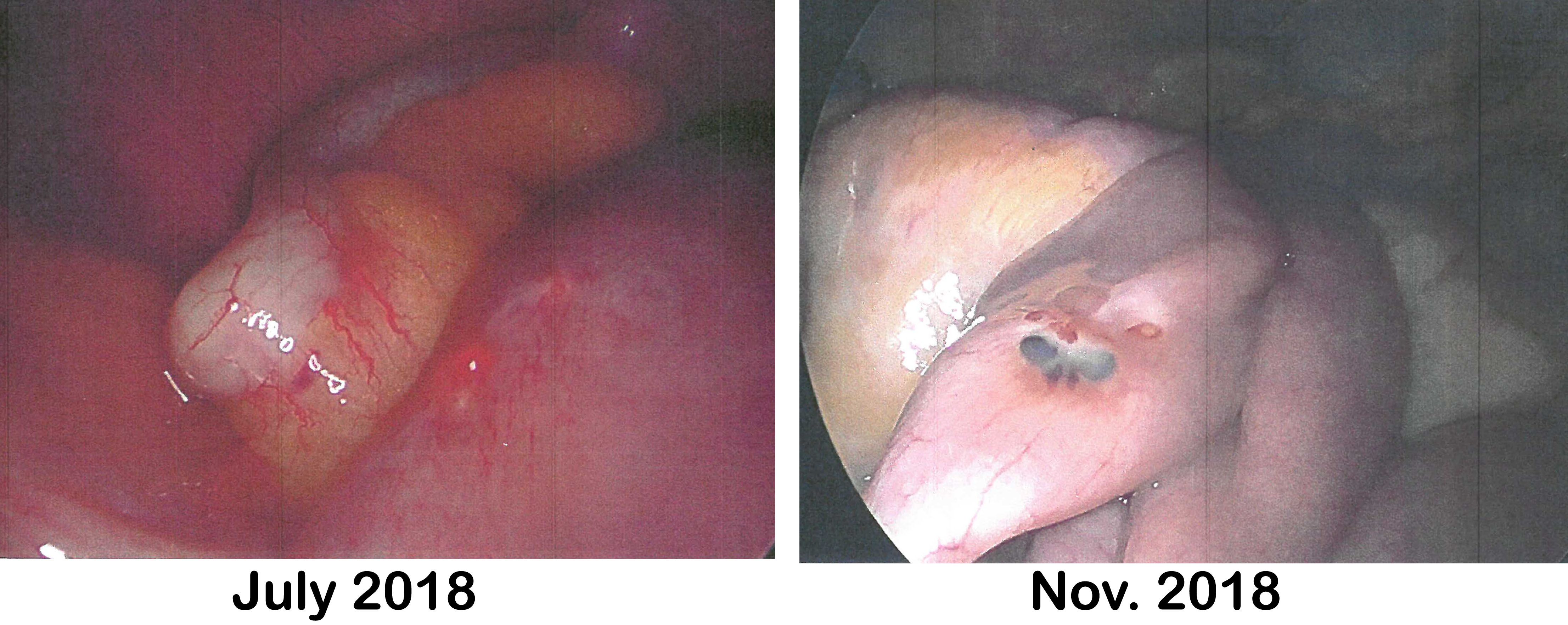 Comparison photos of July 2018 and November 2018 Endo lesions on bowel